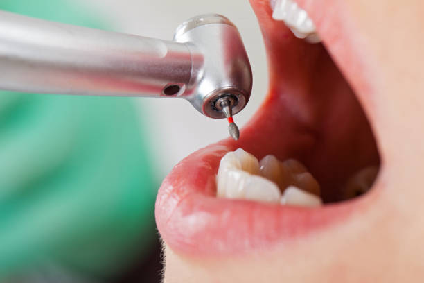 Best Emergency Dental Care for Broken or Chipped Teeth in Fort Stockton, TX